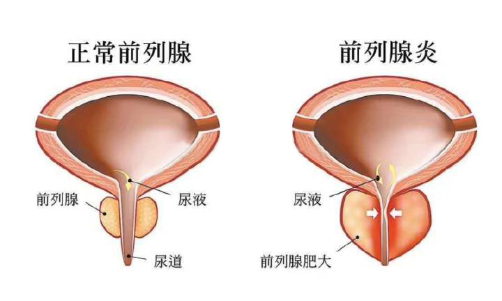 前列腺炎最新研究突破，開啟未來治療新篇章